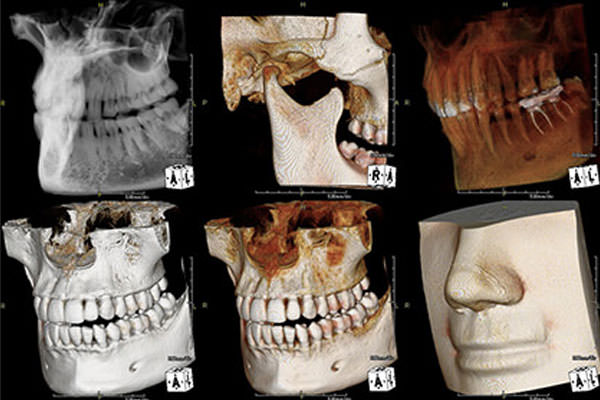 レントゲン写真