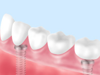 マグネットデンチャー