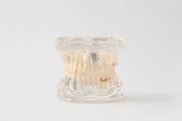 インプラント治療をお考えの方へ