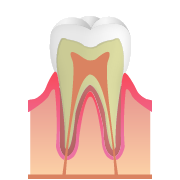 CO（初期のむし歯）