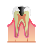 C3（神経のむし歯）