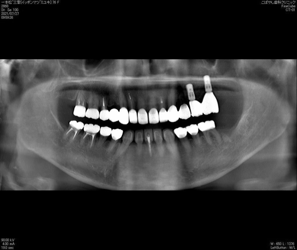 治療後レントゲン